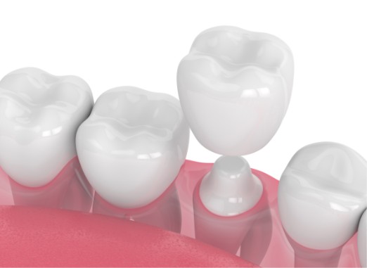 Same-Day Dental Crowns